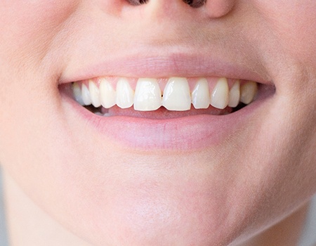 person smiling before getting dental bonding in Azle