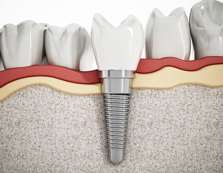 animation of implant supported dental crown