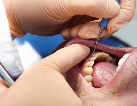 a patient having their teeth scaled