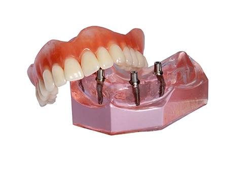 Plastic model of an implant-retained denture.
