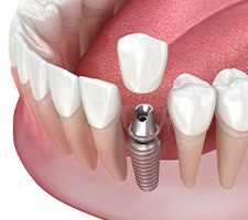 Illustration of a single dental implant