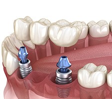Illustration of an implant bridge