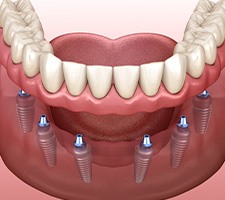 Illustration of an implant denture
