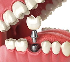 A digital image of the metal abutment used to connect the implant and restoration in Azle