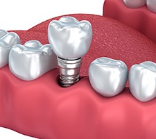A digital image of the finalized restoration placed on top of a single tooth dental implant in Azle