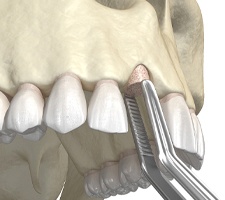 diagram of a bone graft in Azle