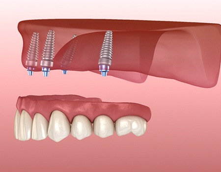 All-on-4 in Azle, TX for full dentures on upper arch