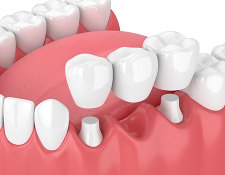 dental bridge replacing a single missing tooth 