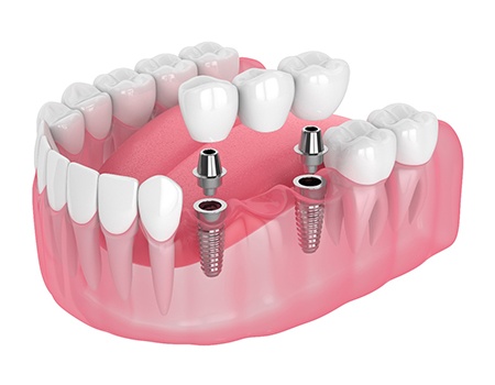 two dental implants supporting a dental bridge 