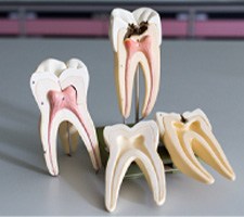Four models of teeth showing inner tooth roots 
