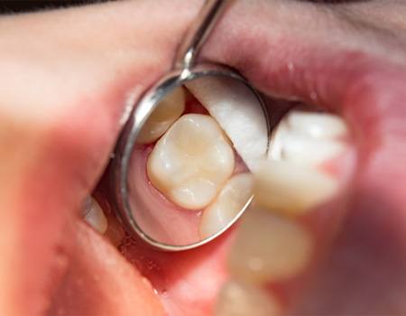 Close up of a filled tooth