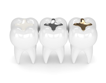  Model of dental fillings made of various materials