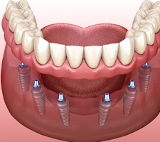 Digital illustration of implant dentures in Azle