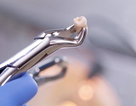 dentist in Azle holding an extracted tooth with dental forceps  