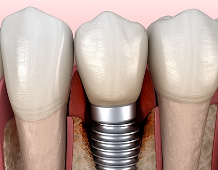 Render of a failed dental implant in Baltimore, MD
