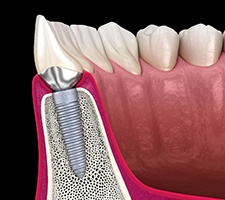 dental implant post in the lower jawbone 