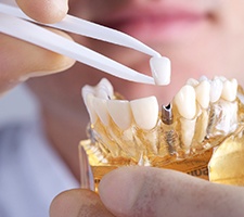 dentist placing a crown on a dental implant model 