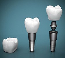 crown and abutment being placed on a dental implant