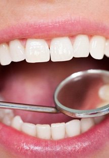 Close up of dental mirror examining a patient’s teeth