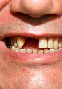 Man smiling to reveal a missing tooth