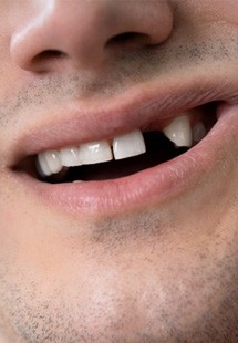 patient smiling with gap in his smile 