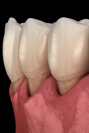 computer illustration of receding gums caused by gum disease