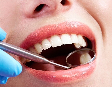 Closeup of smile during dental treatment