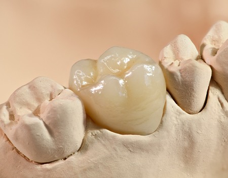 Model smile with dental crown restoration