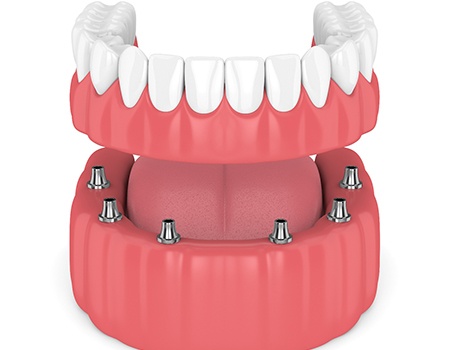 Model of an implant-retained denture.