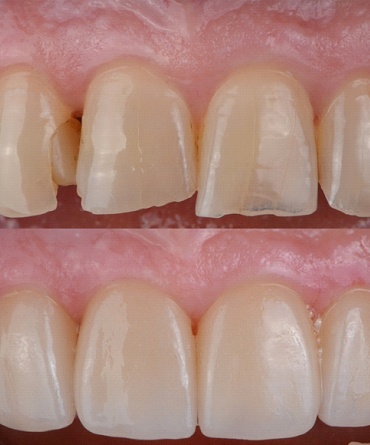 a before and after photo of a smile makeover