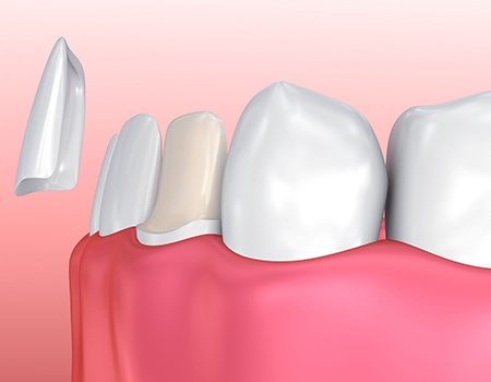 diagram of veneer being placed on front bottom tooth 