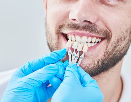 dentist holding veneers up to a patient’s front teeth 