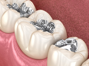 3D render of a metal dental filling
