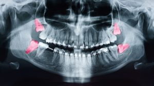 X-ray showing wisdom teeth tinted red