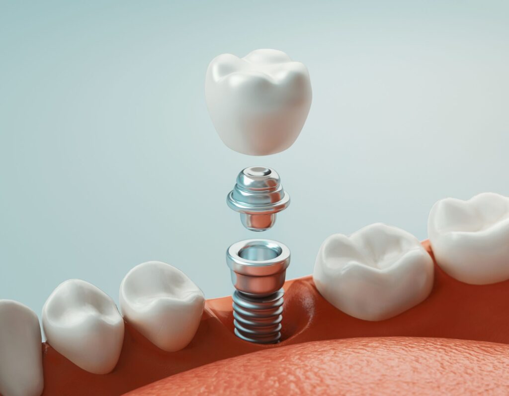 Illustration of components of a dental implant in a lower arch