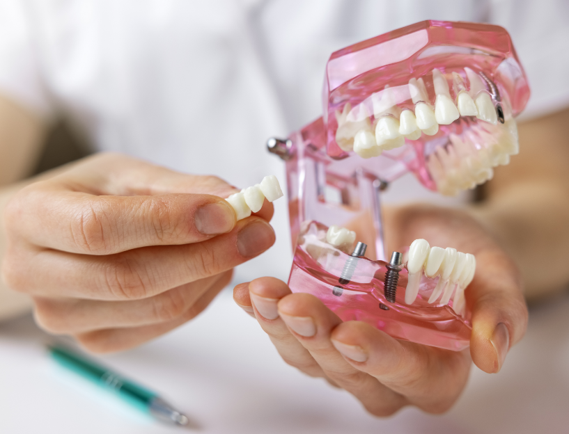 Dentist holding dental implant model