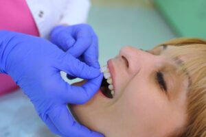 Dentist applying veneers.