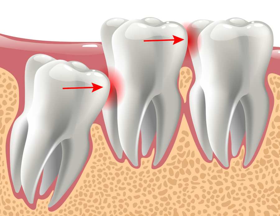 Illustrated cross section of wisdom tooth