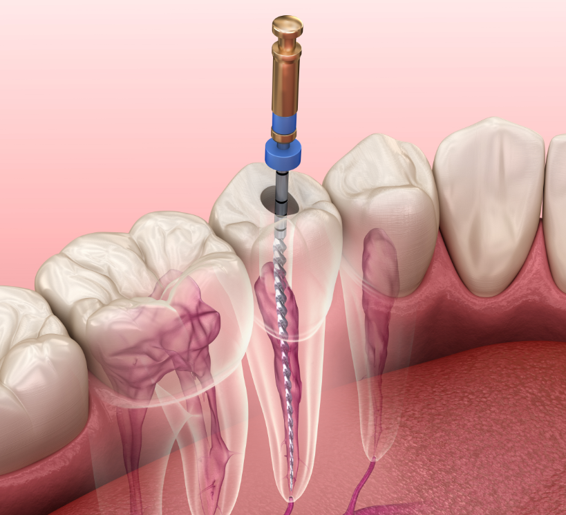3D cross section of a root canal